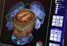 Brain tissue grown on semiconductor chip could lead to neural prosthetics Brain tissue grown on semiconductor chip