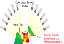 Radiation Treatment for Diseases